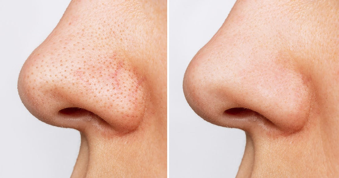 Comparative images of a woman's nose, depicting the transformation and clearer skin after treatment for blackheads.