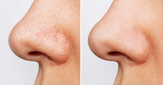 Comparative images of a woman's nose, depicting the transformation and clearer skin after treatment for blackheads.