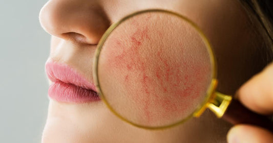 A woman inspects her skin with a magnifying glass, focusing on issues related to over-exfoliation and healing methods.