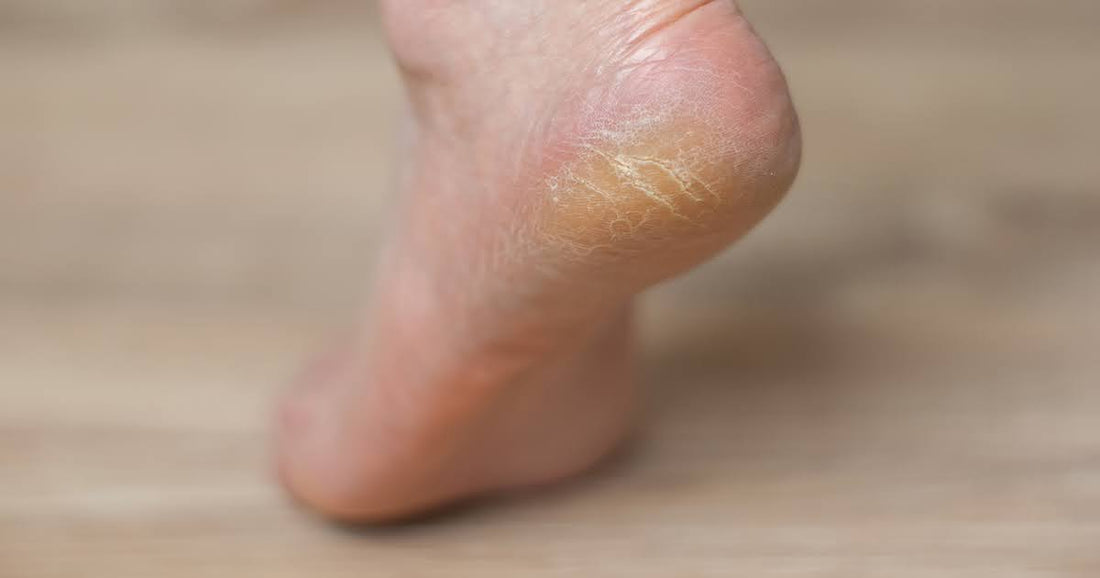 A close-up of a person's foot showing a small patch of dry skin, illustrating tips for removing dead skin on feet.