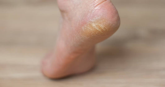 A close-up of a person's foot showing a small patch of dry skin, illustrating tips for removing dead skin on feet.